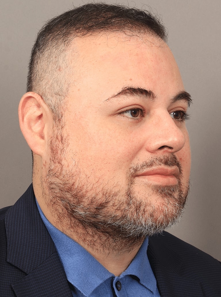 Buccal Fat Removal Before & After