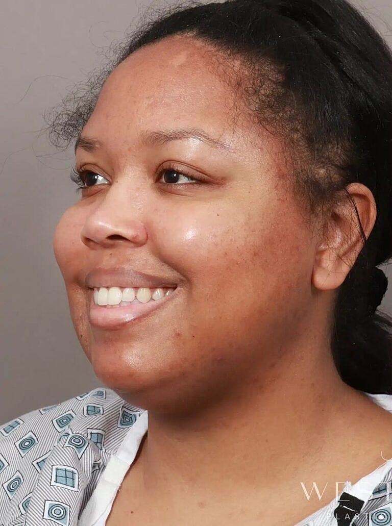 Buccal Fat Removal Before & After