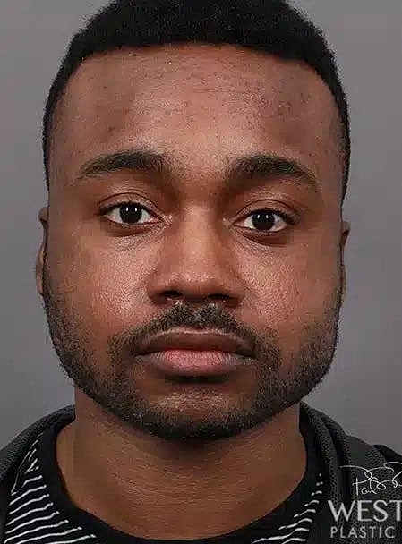 Buccal Fat Removal Before & After