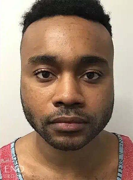 Buccal Fat Removal Before & After