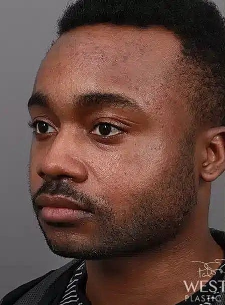 Buccal Fat Removal Before & After