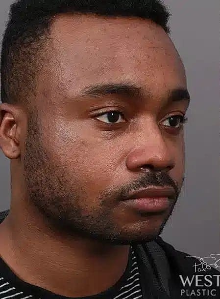 Buccal Fat Removal Before & After