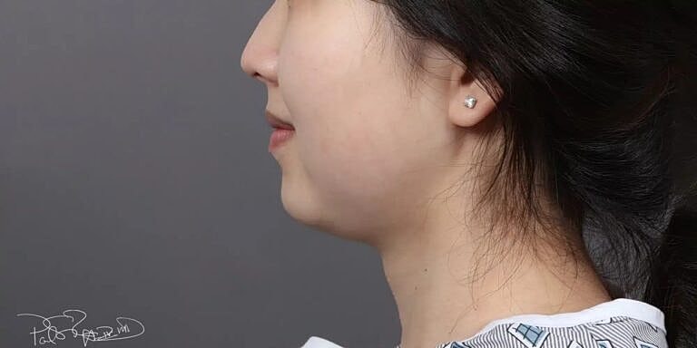 Buccal Fat Removal Before & After