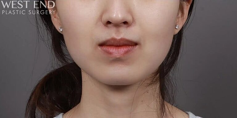 Buccal Fat Removal Before & After