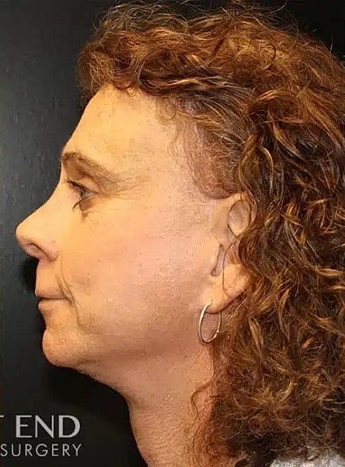 Facial Feminization Surgery Before & After