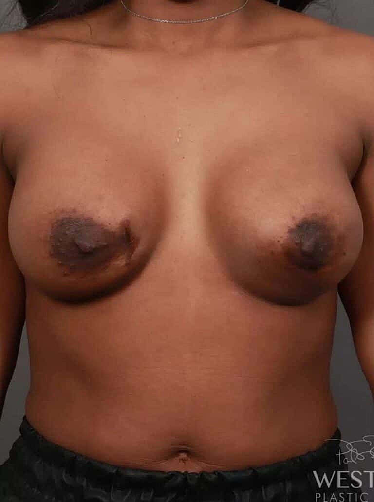 Breast Implant Exchange Before & After
