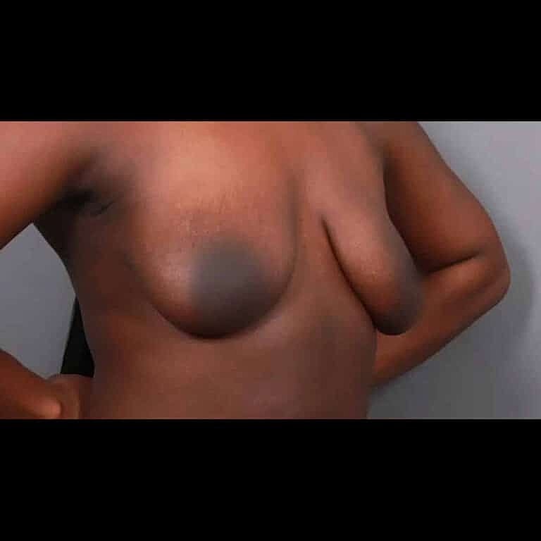 Breast Implant Exchange Before & After