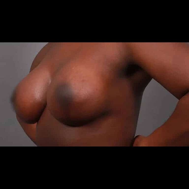 Breast Implant Exchange Before & After