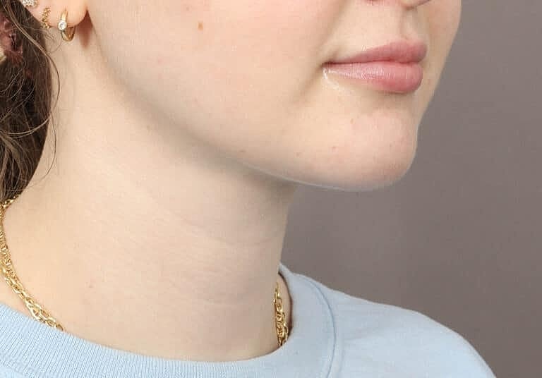 Renuvion Before & After