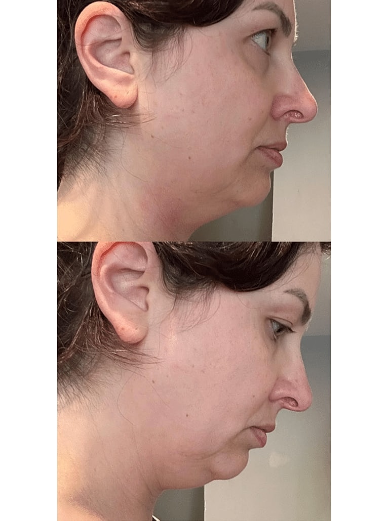 Renuvion Before & After