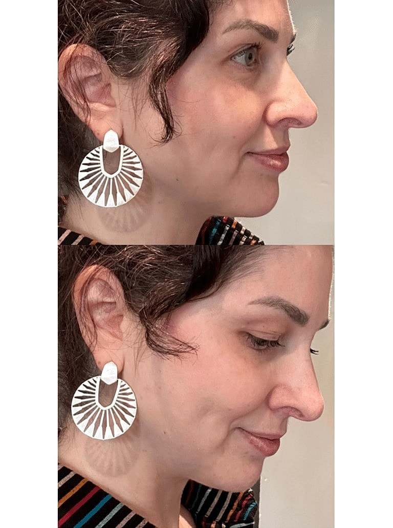 Renuvion Before & After