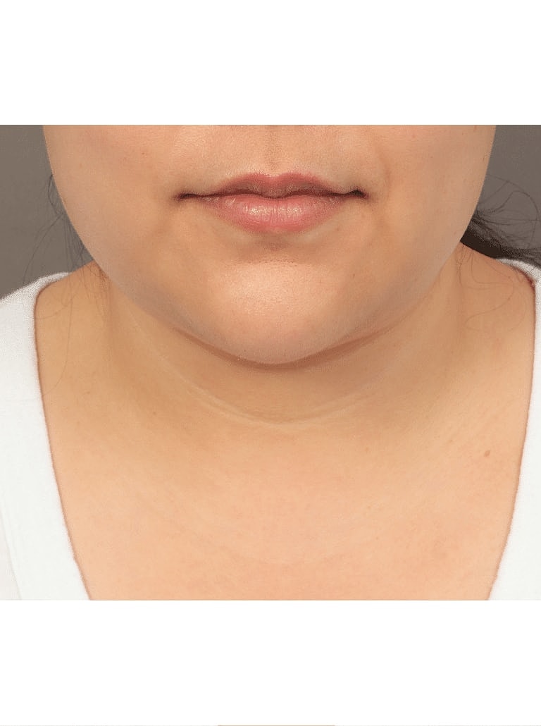 Renuvion Before & After