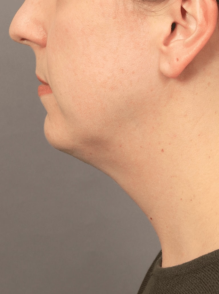 Renuvion Before & After