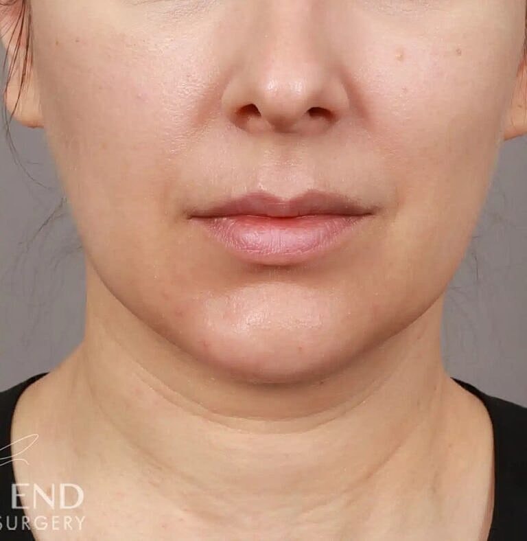 Renuvion Before & After