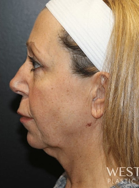 Renuvion Before & After