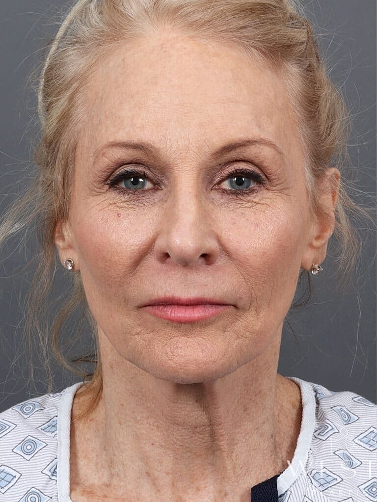 Renuvion Before & After