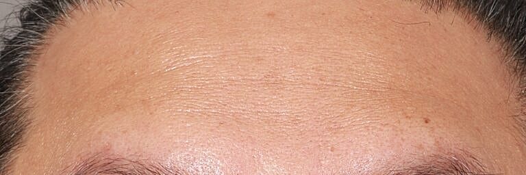 Renuvion Before & After