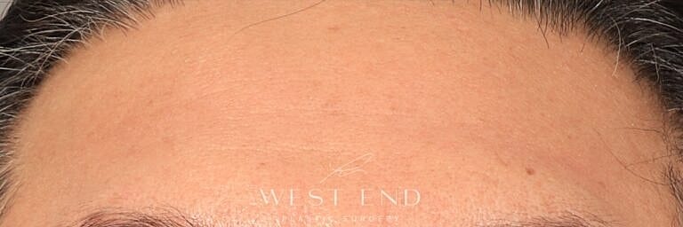 Renuvion Before & After