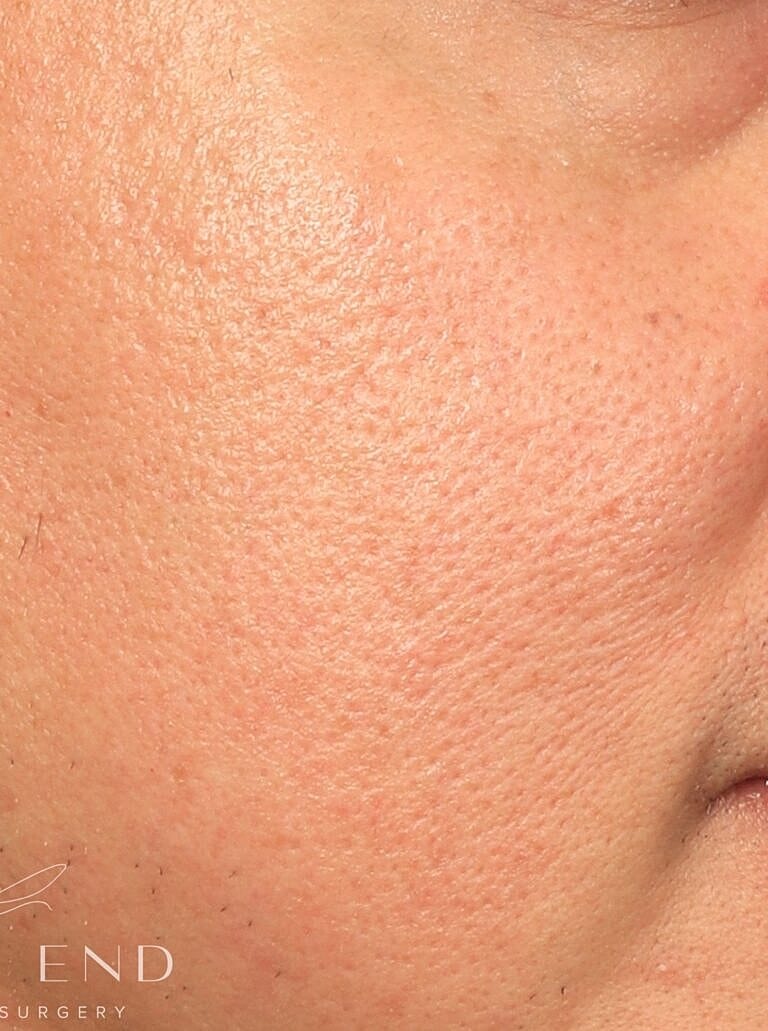 Renuvion Before & After