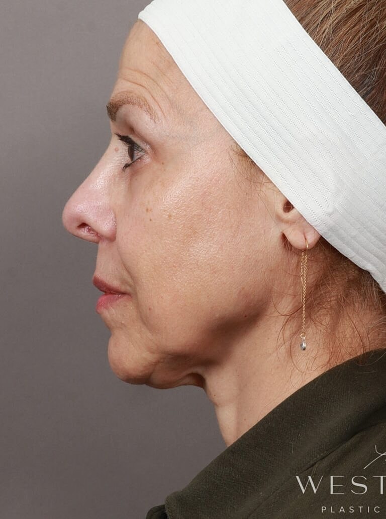 Renuvion Before & After