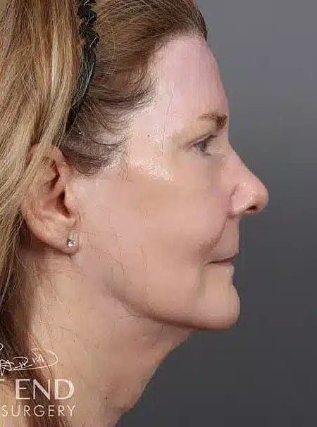 Renuvion Before & After