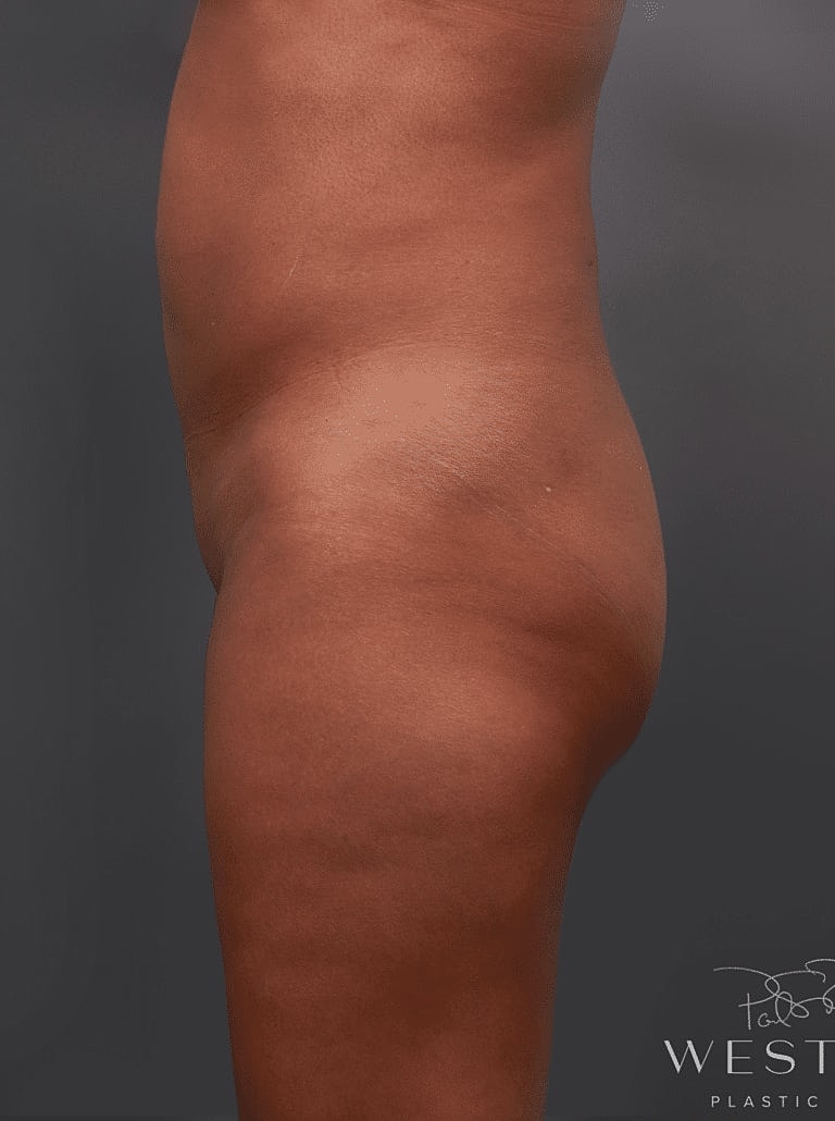 Brazilian Butt Lift Before & After