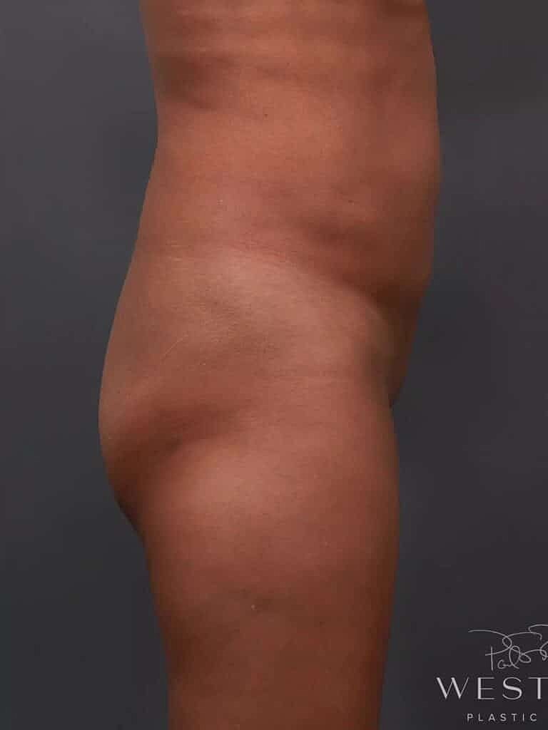 Brazilian Butt Lift Before & After