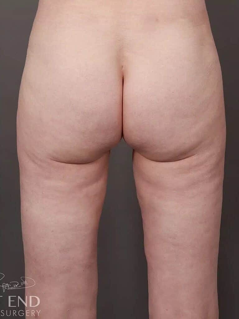 Brazilian Butt Lift Before & After