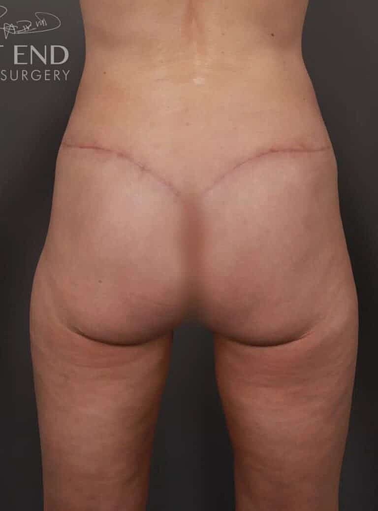 Brazilian Butt Lift Before & After