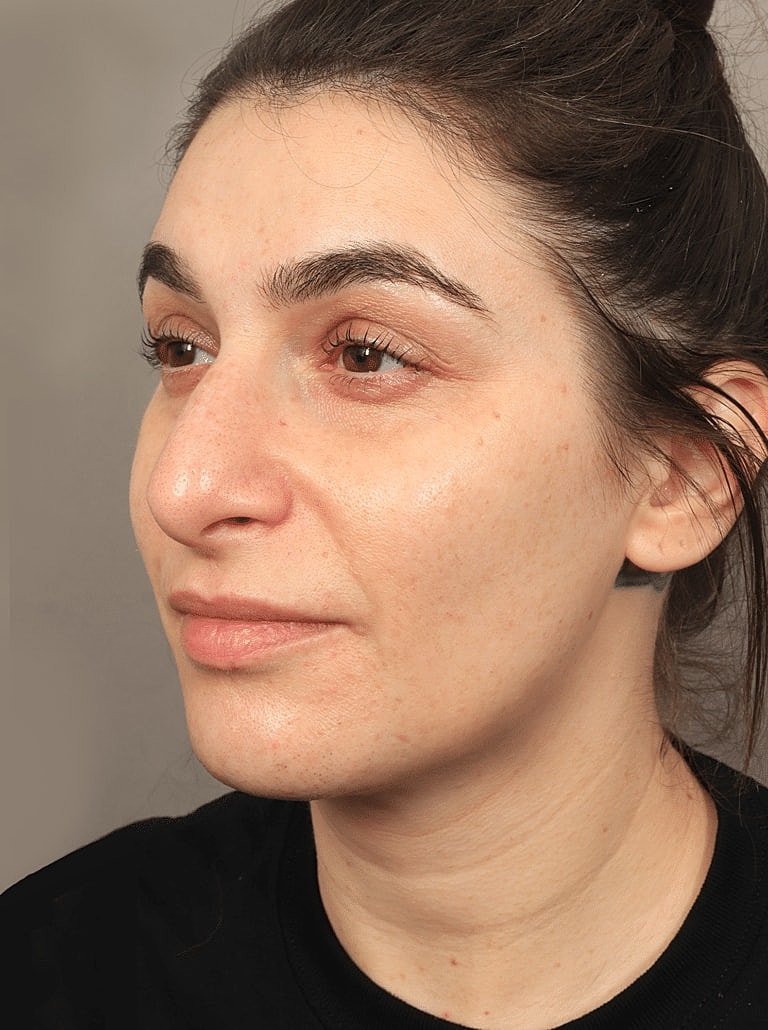 Dermal Fillers Before & After