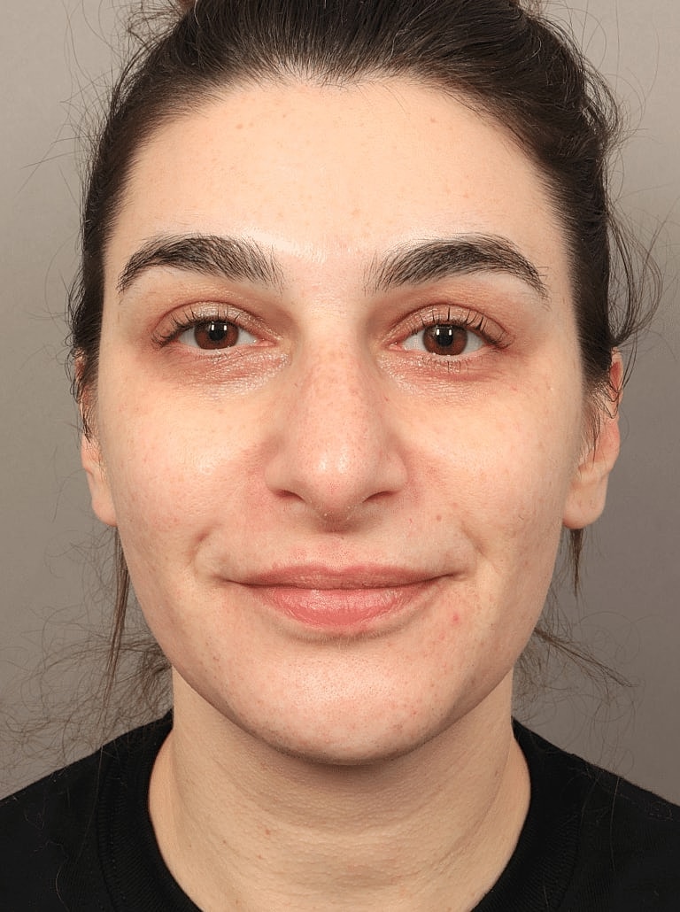 Dermal Fillers Before & After