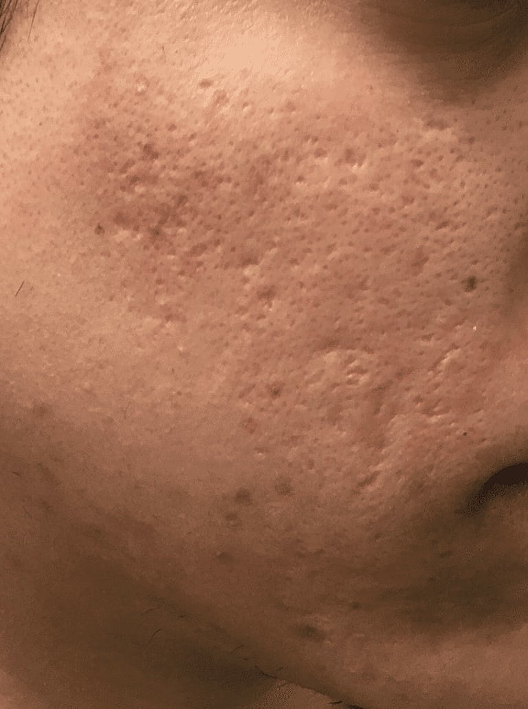 Dermal Fillers Before & After