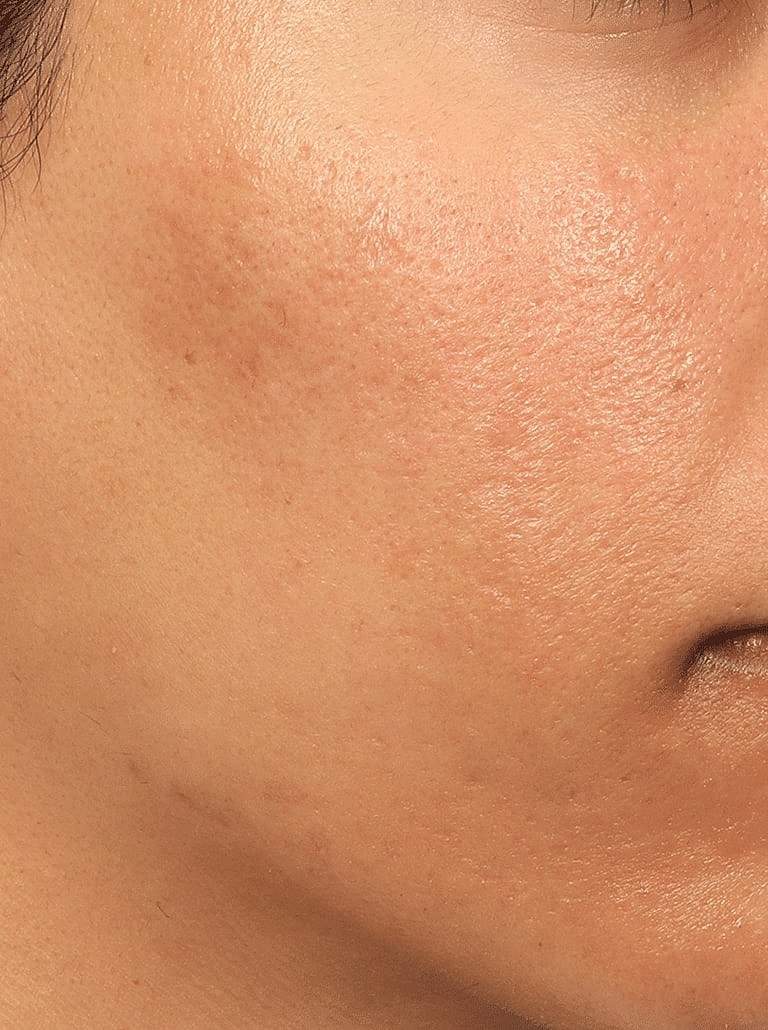 Dermal Fillers Before & After