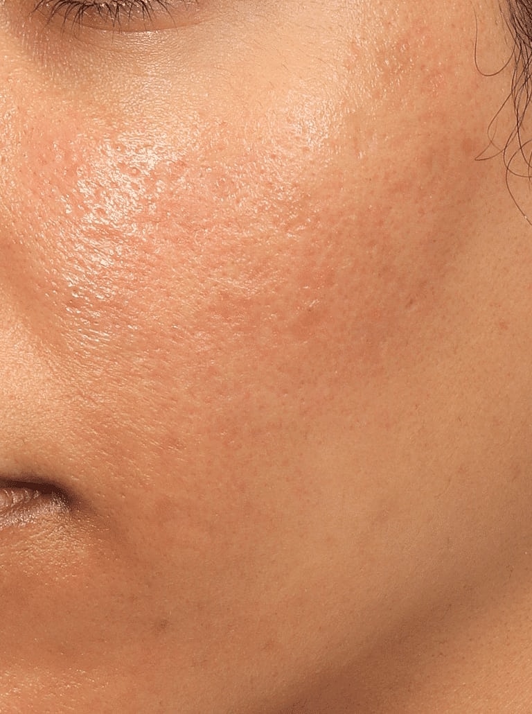 Dermal Fillers Before & After