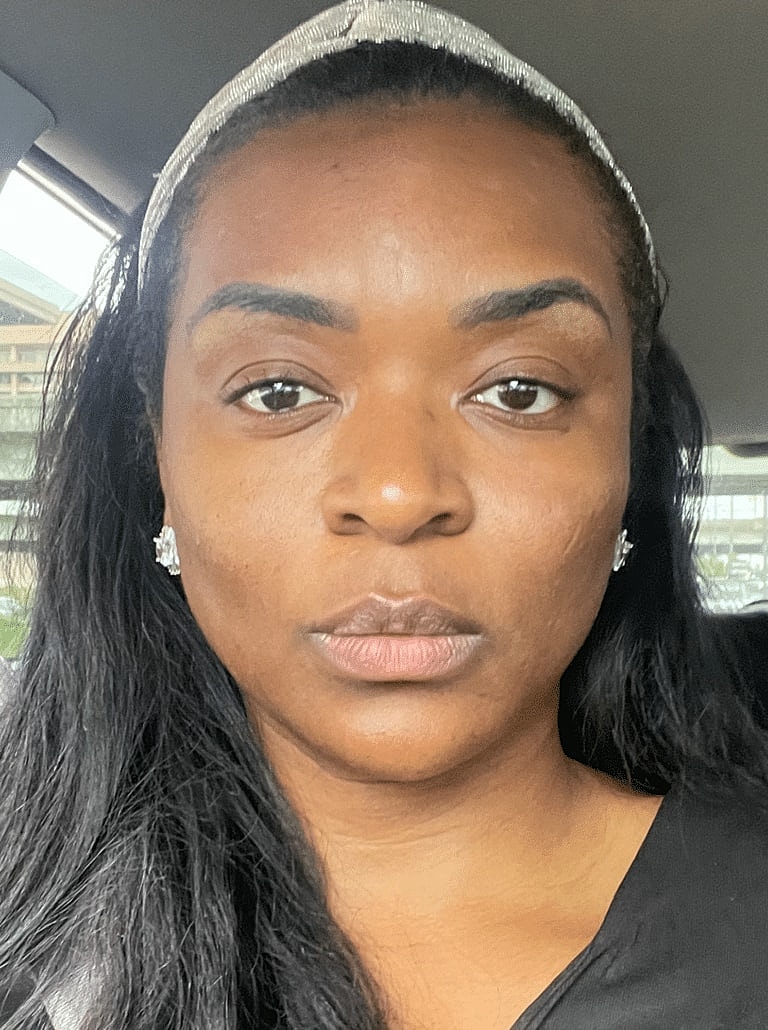 Dermal Fillers Before & After