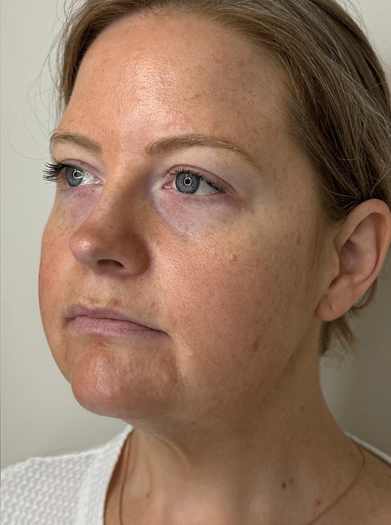 Dermal Fillers Before & After