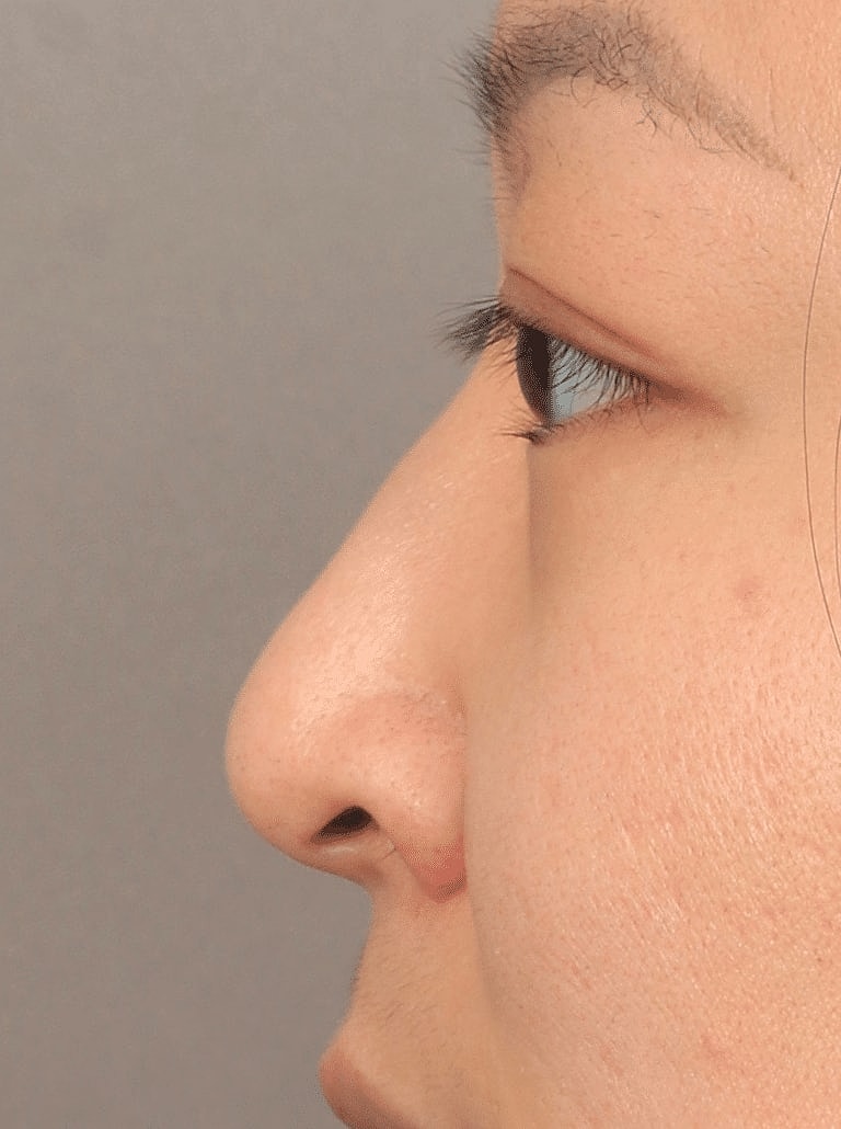 Dermal Fillers Before & After