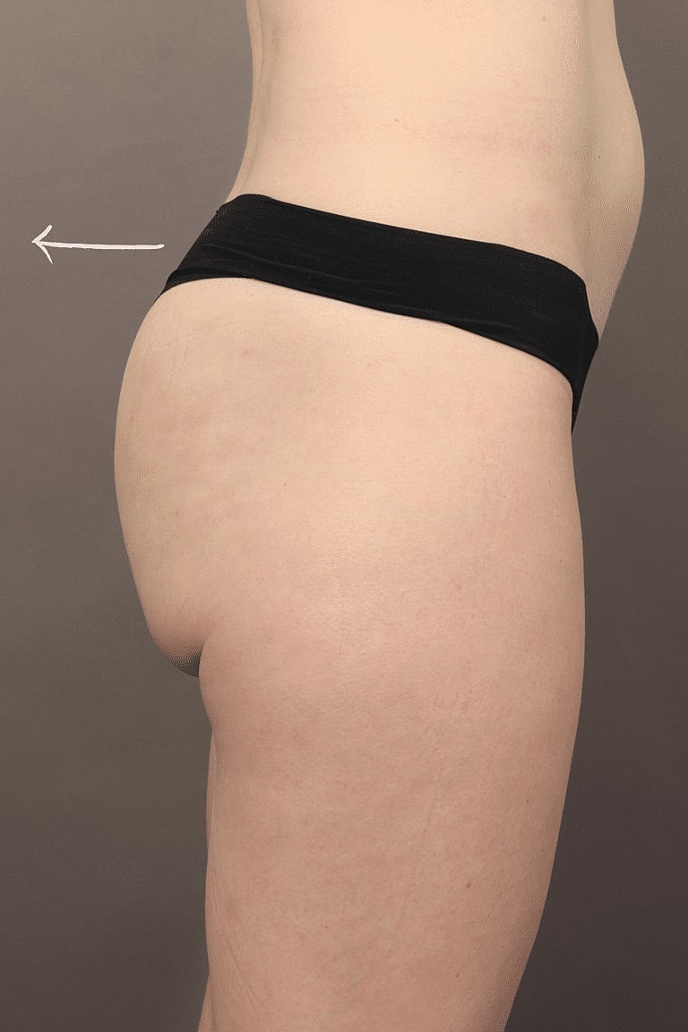 Dermal Fillers Before & After