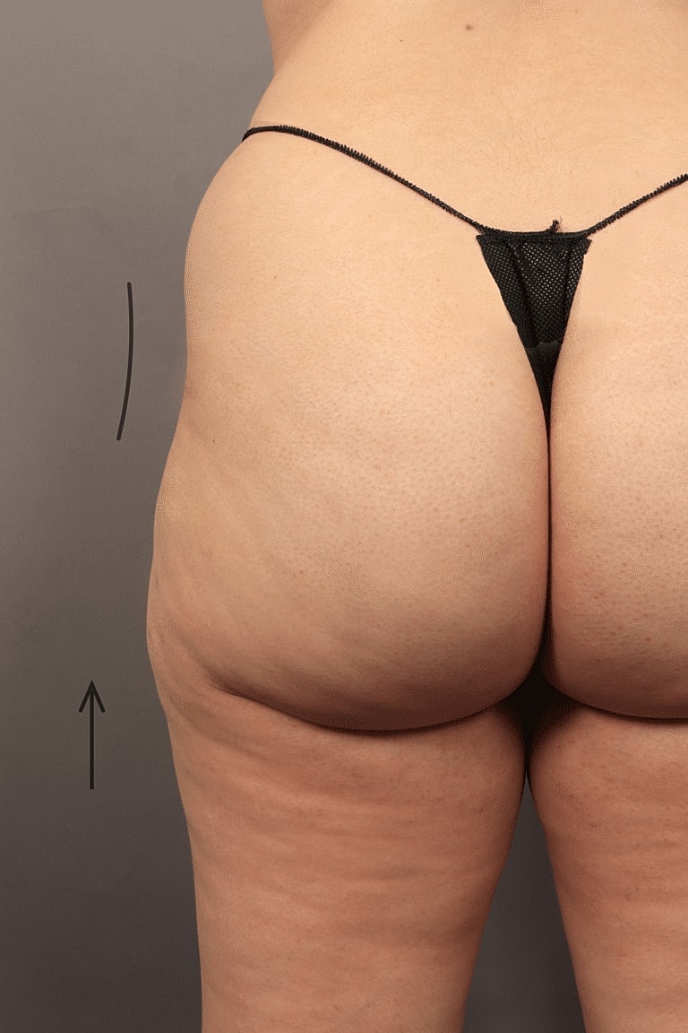 Dermal Fillers Before & After