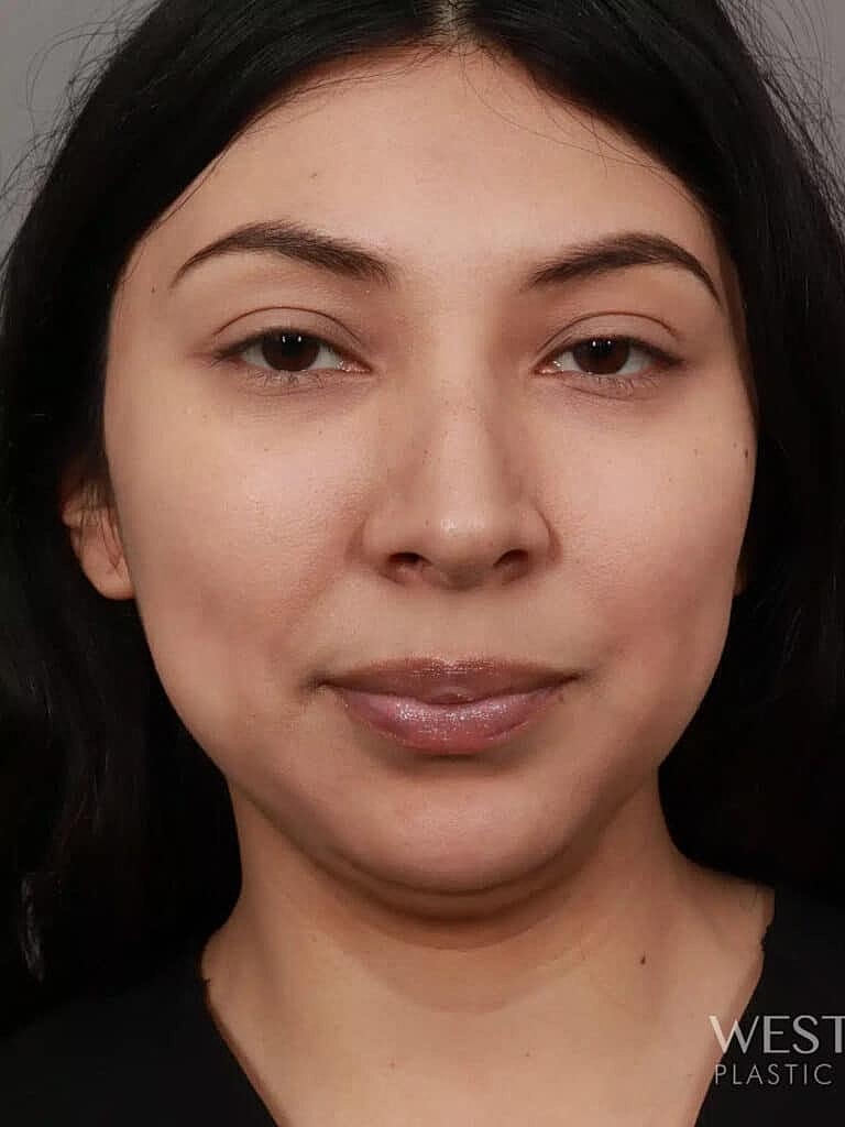 Dermal Fillers Before & After