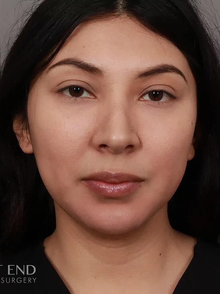 Dermal Fillers Before & After