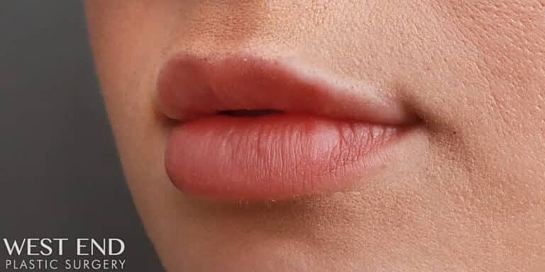 Dermal Fillers Before & After