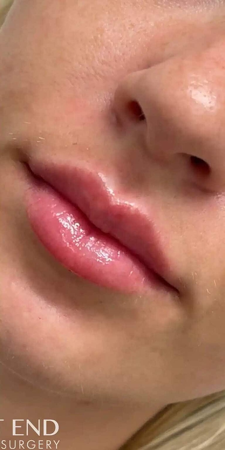 Dermal Fillers Before & After