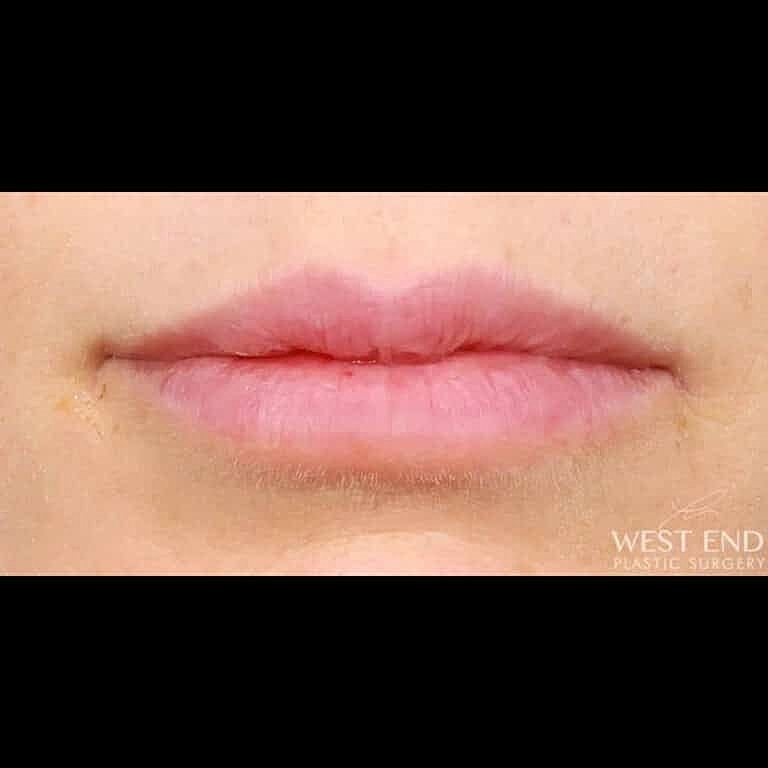 Dermal Fillers Before & After