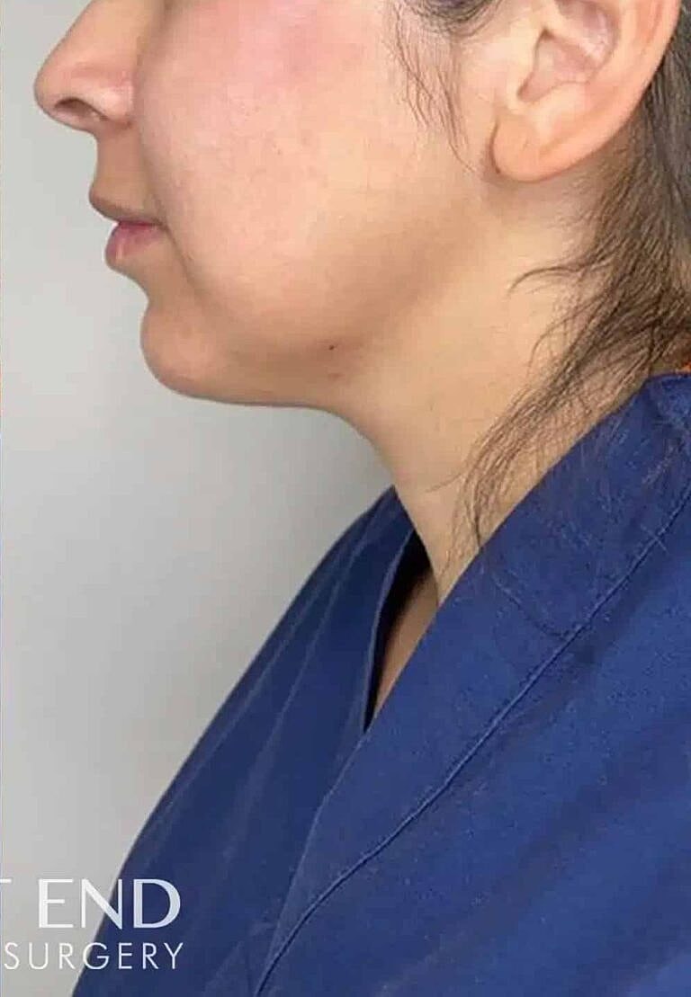 Dermal Fillers Before & After