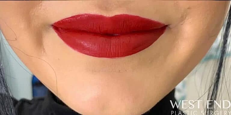 Dermal Fillers Before & After