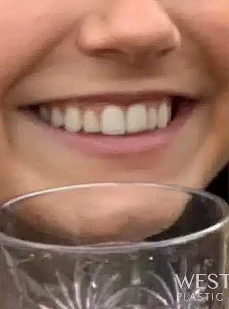 Dermal Fillers Before & After