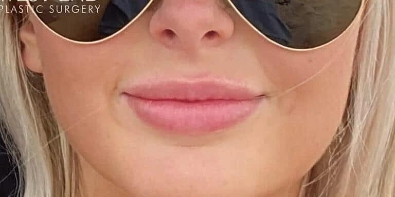 Dermal Fillers Before & After