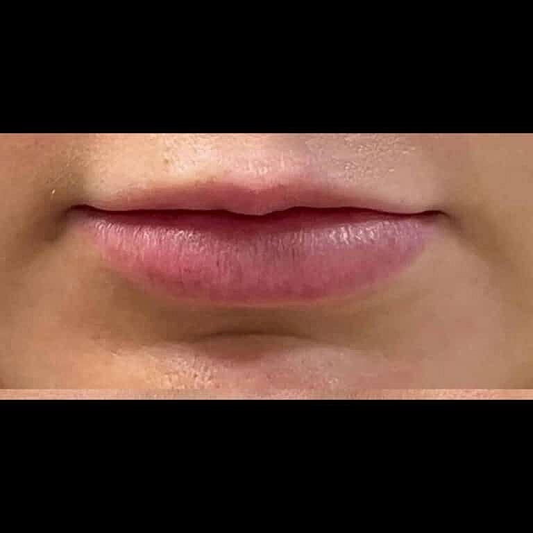 Dermal Fillers Before & After