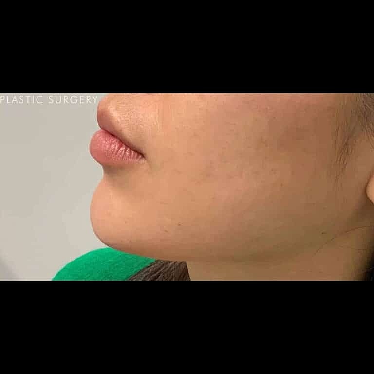 Dermal Fillers Before & After